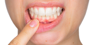 parodontie ou gingivite