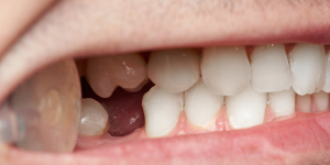 restauration dentaire pont