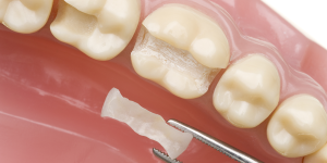 restauration dentaire incrustation